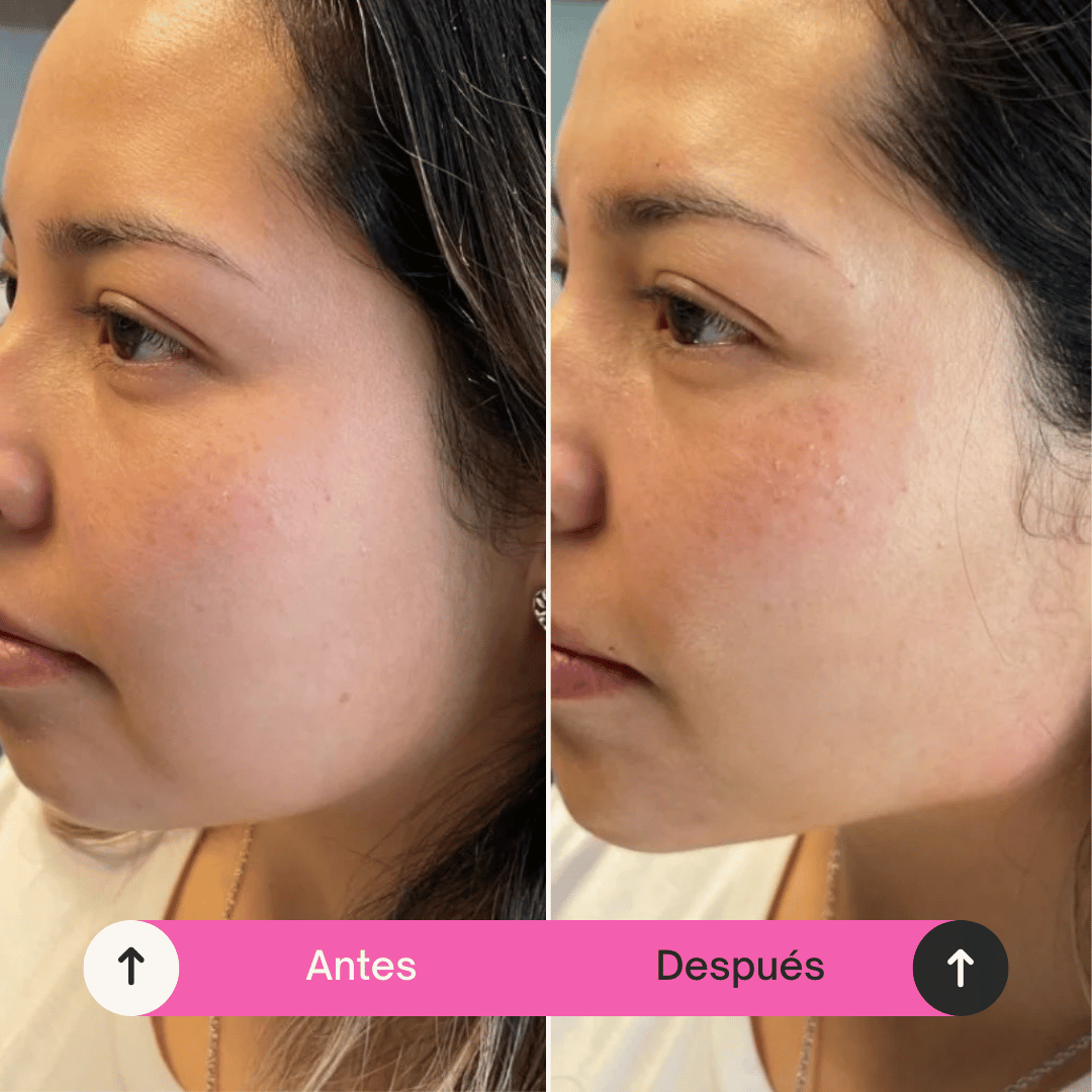Reductor Papada Kaisy Lift Pro