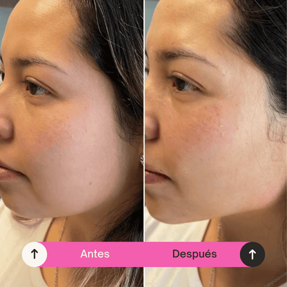 Reductor Papada Kaisy Lift Pro